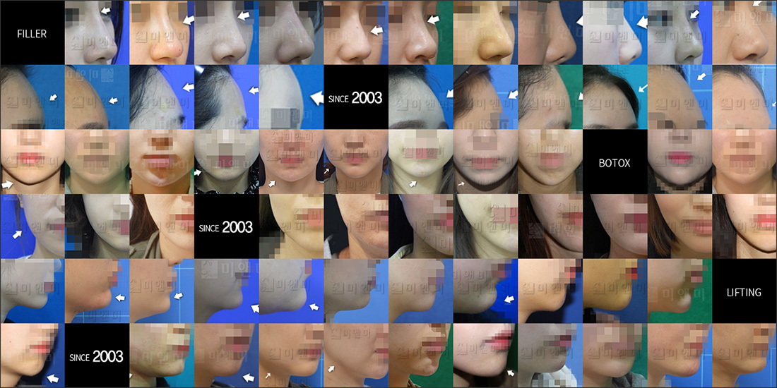 SINCE 2003 MI&MI, 시술후사진모음 명동소노케어,명동역소노케어